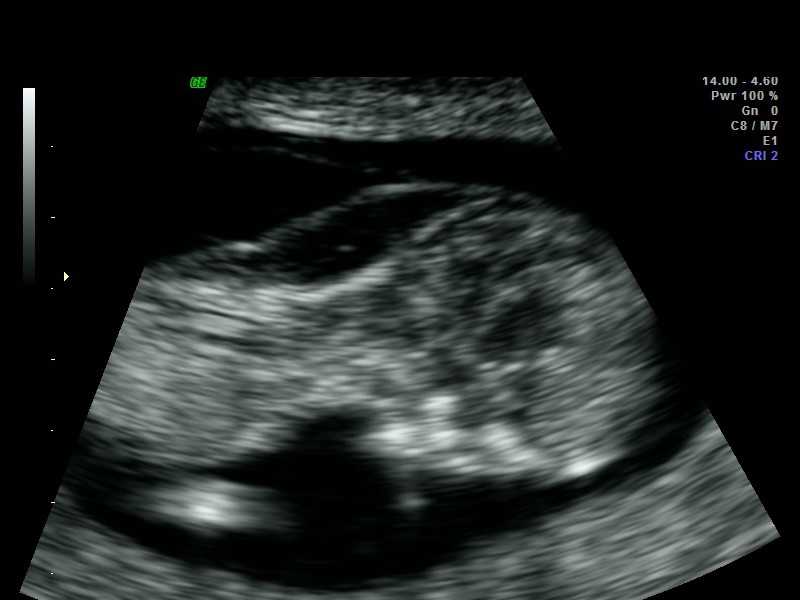 Cystic Hygroma: Note septations