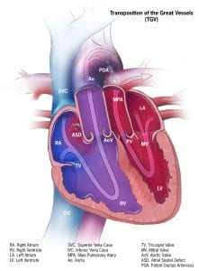 Transposition of the Great Arteries