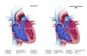 Ventricular Septal Defect