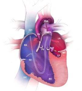 Hypoplastic Left Heart Syndrome