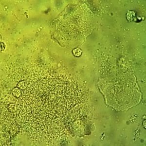 Vaginal wet mount with a clue cell