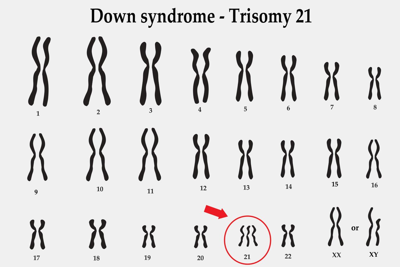 Trisomy 21 The Obg Project 