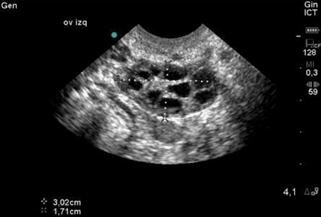 Ovarian Reserve Testing and Diagnosing Diminished Ovarian Reserve The Ovarian Reserve Testing and Diagnosing Diminished Ovarian Reserve The