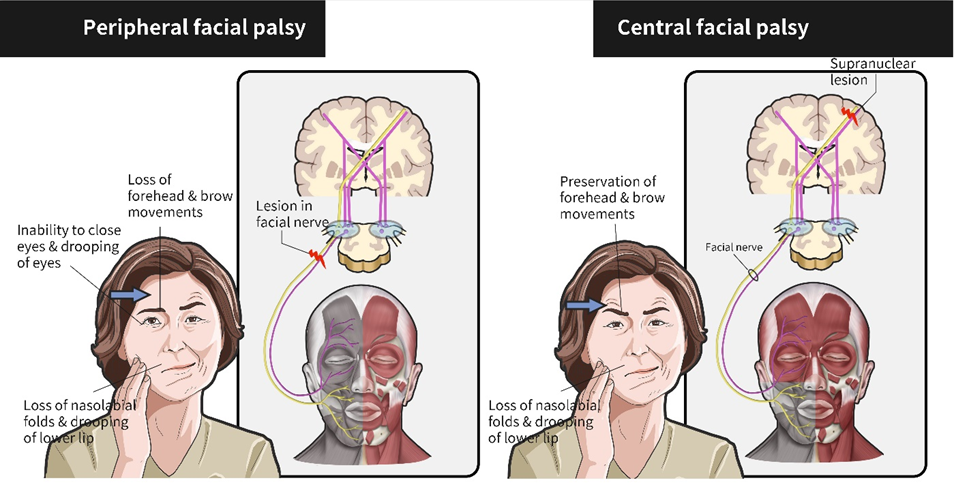 17 Bells Palsy ideas  bells palsy, types of facials, paralysis