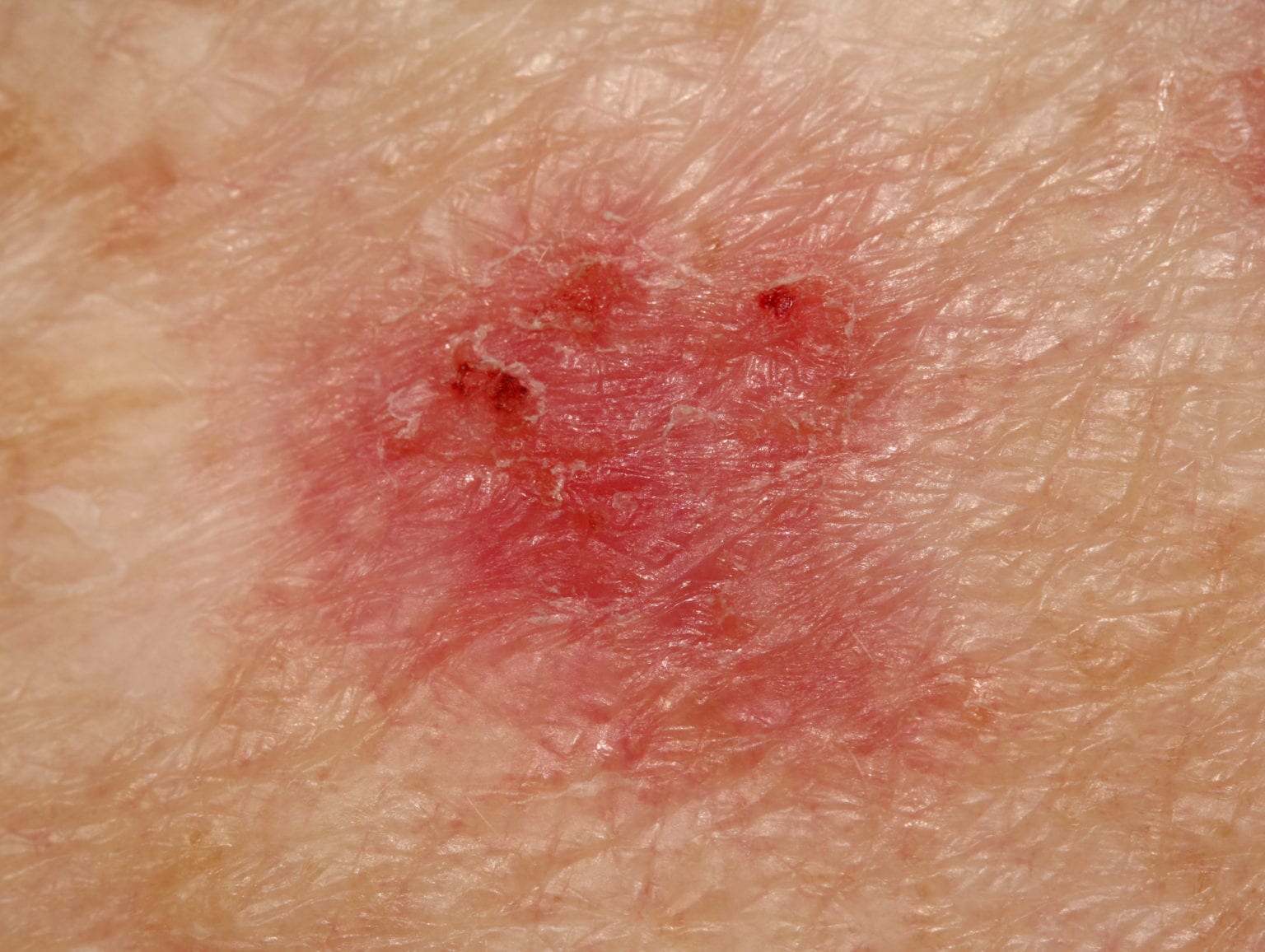 Basal Cell Carcinoma: Clinical Presentation and Management - The ObG