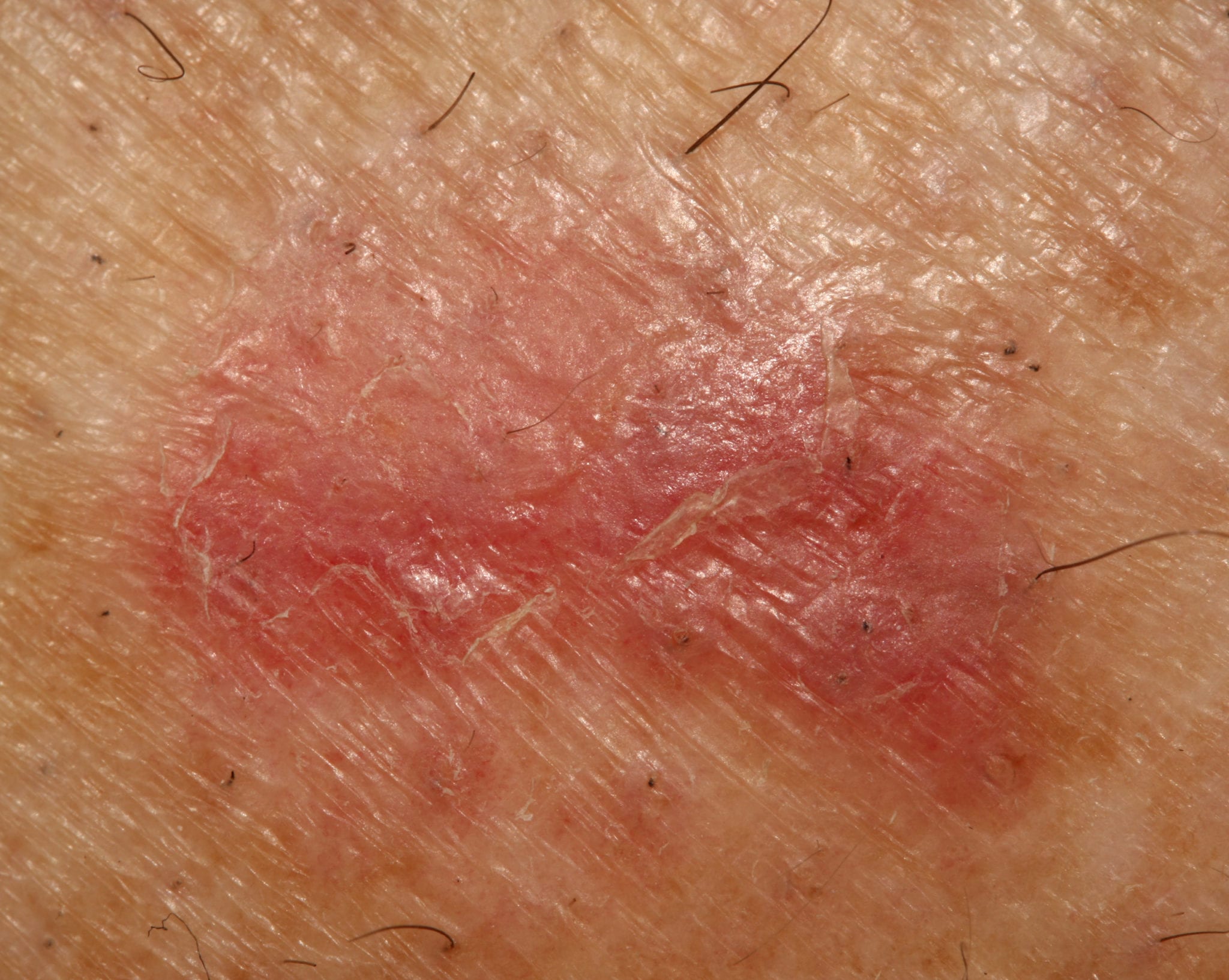 Basal Cell Carcinoma Clinical Presentation and Management The ObG